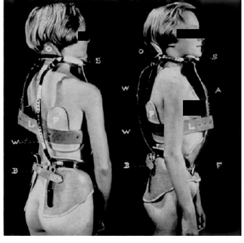 2 side by sde b/w photos of a young white woman wearing only a Milwaukee back brace, with black bars covering her eyes and breasts. On the left is her back, on the right, she's in profile.
